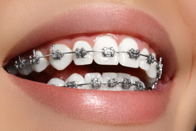 A manutenção do aparelho dentário na Irlanda não é tão diferente que no Brasil. Crédito: Shutterstock